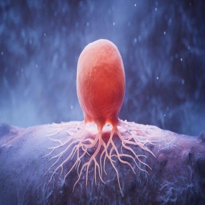 سرطان سینه شایع‌ترین سرطان در کردستان